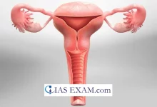 Hysterectomy UPSC