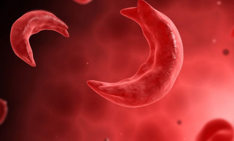 Sickle Cell Disease UPSC
